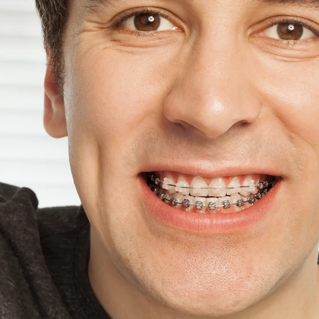 Close-up of a smile with clear brackets on the upper teeth